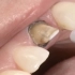 【深圳镶牙】牙齿戴牙冠的过程是怎样的？烤瓷牙要多少钱？