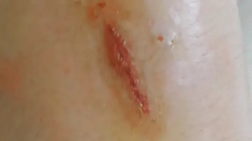 伤口结痂了，比前几天看起来好多了，周围红肿消退了，但是医院这批纱布好硬，包了一晚上，纱布过敏了，四四方方的范围起了过敏红斑。只能拆了把伤口裸露出来。