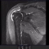 肩袖撕裂磁共振诊断实战病例分析（二）——难度：青铜