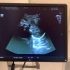 孕38周B超产检实录，医生说胎头已经下降，大概一周左右就会生！
