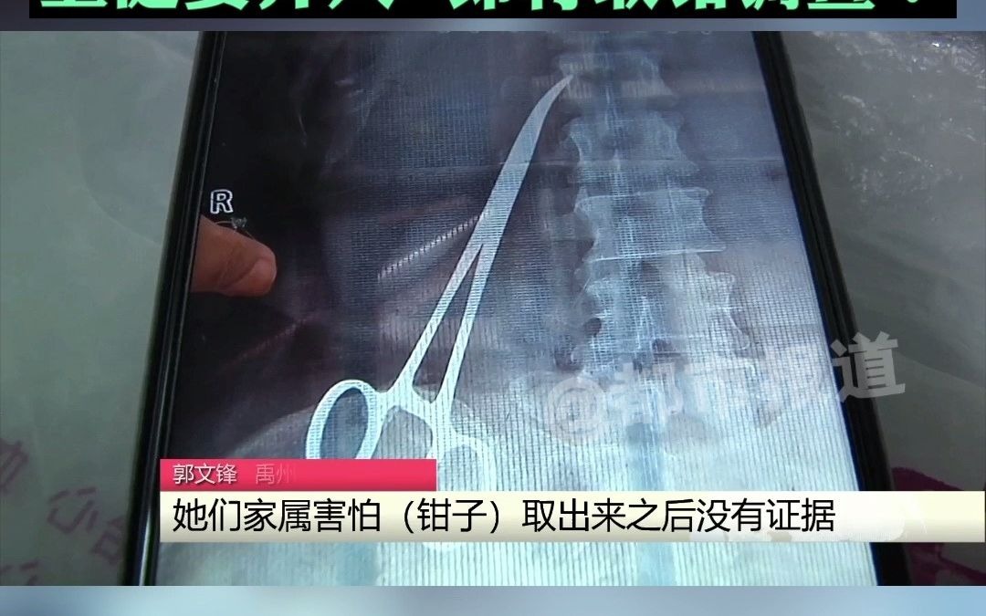 都市报道【剖宫产后腰疼一年，腹中竟藏15公分长止血钳？当地卫健委介入，即将取钳调查！】