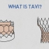 什么是TAVR（TAVI）经导管主动脉瓣介入术