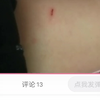 这种程度是不会得破伤风的，小学生弟弟 你以后多注意点就行