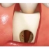 这种慢性根尖周炎，引起的牙齿根尖部肉牙或囊肿，该怎么办呢？一起看看「大连齿医生口腔修复中心」「大连口腔医院」