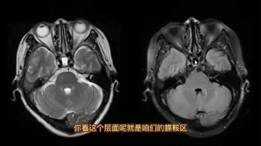 空蝶鞍在MRI上什么表现？典型病例分享，动态图像观察