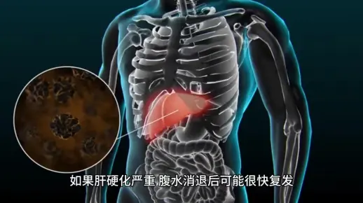 淋滞疏通丸丨肝硬化腹水治疗周期多久