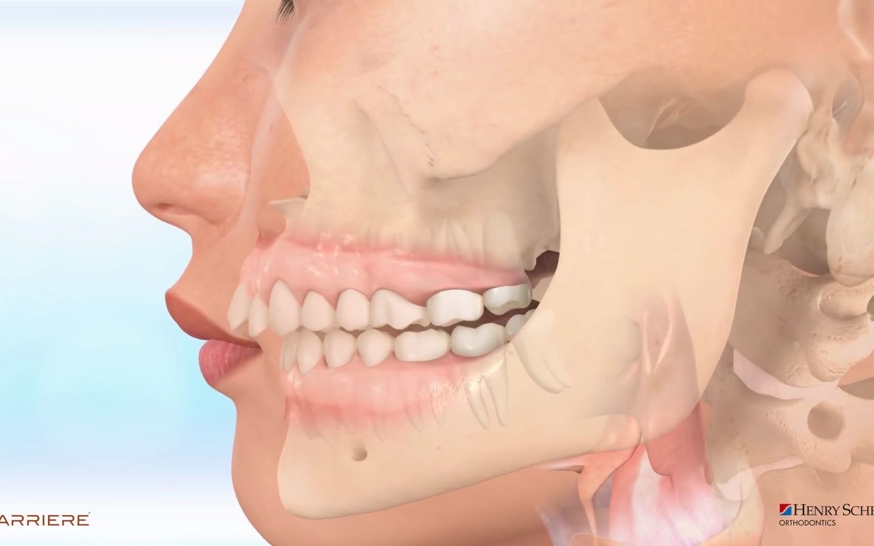 【正畸】深覆盖的矫正过程，并不是所有的三分龅都是好龅牙