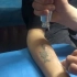 手臂处纹身（许昌德医堂）治疗过程#许昌#洗纹身