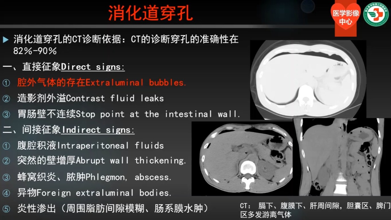 第四讲、消化道穿孔01（共30讲）
