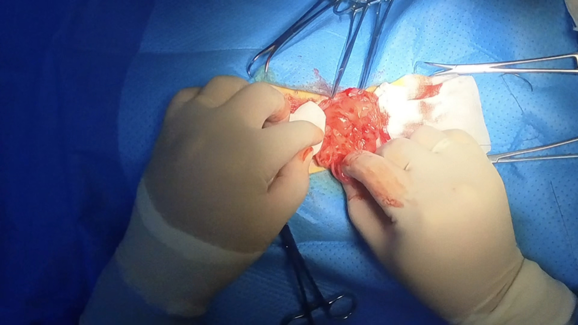 犬蜂窝脾，传统脾脏摘除手术