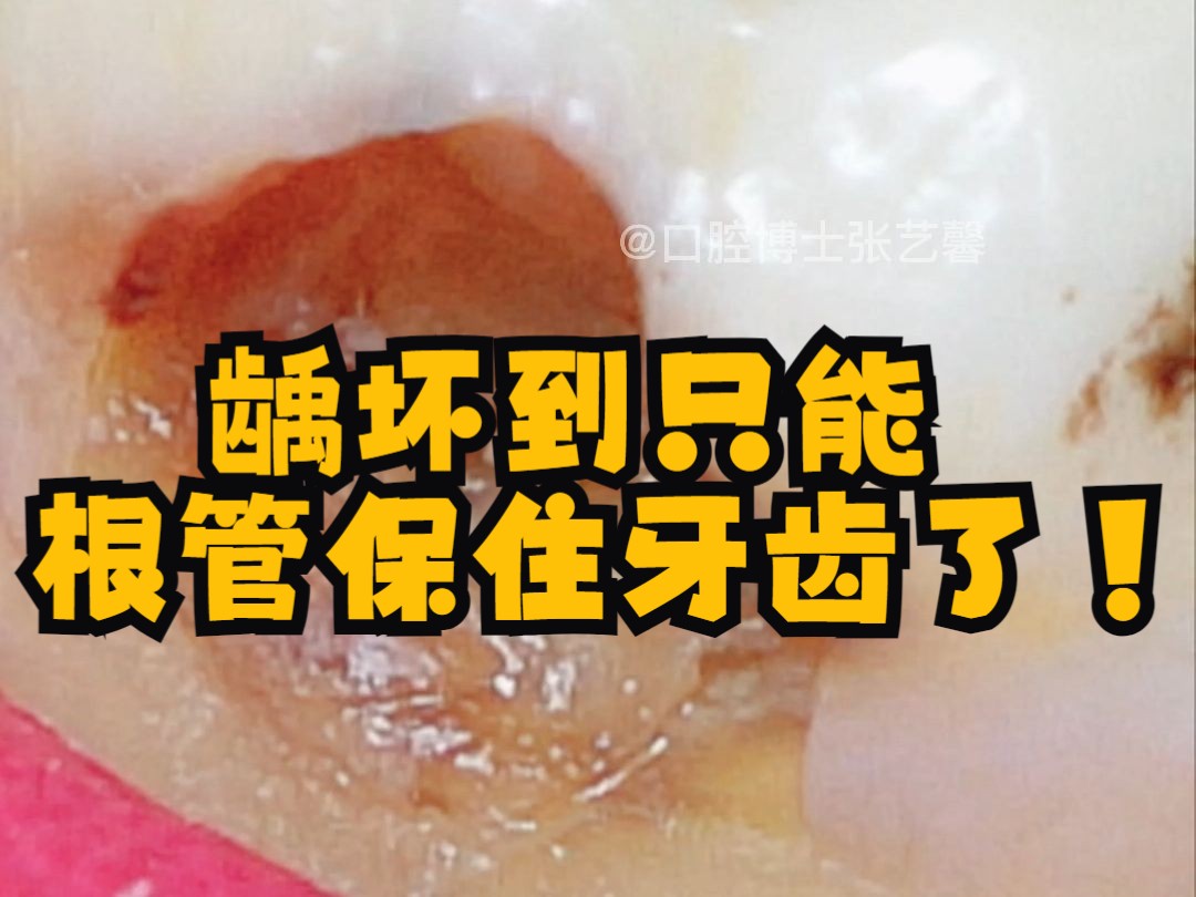 牙齿龋坏已经深入牙髓啦！想要保住就只能做根管治疗~