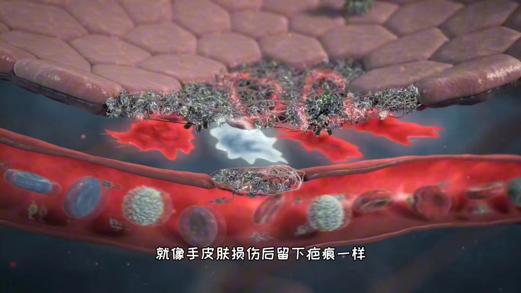 肺为什么会长结节，肺纤维化过程，3D演示。。