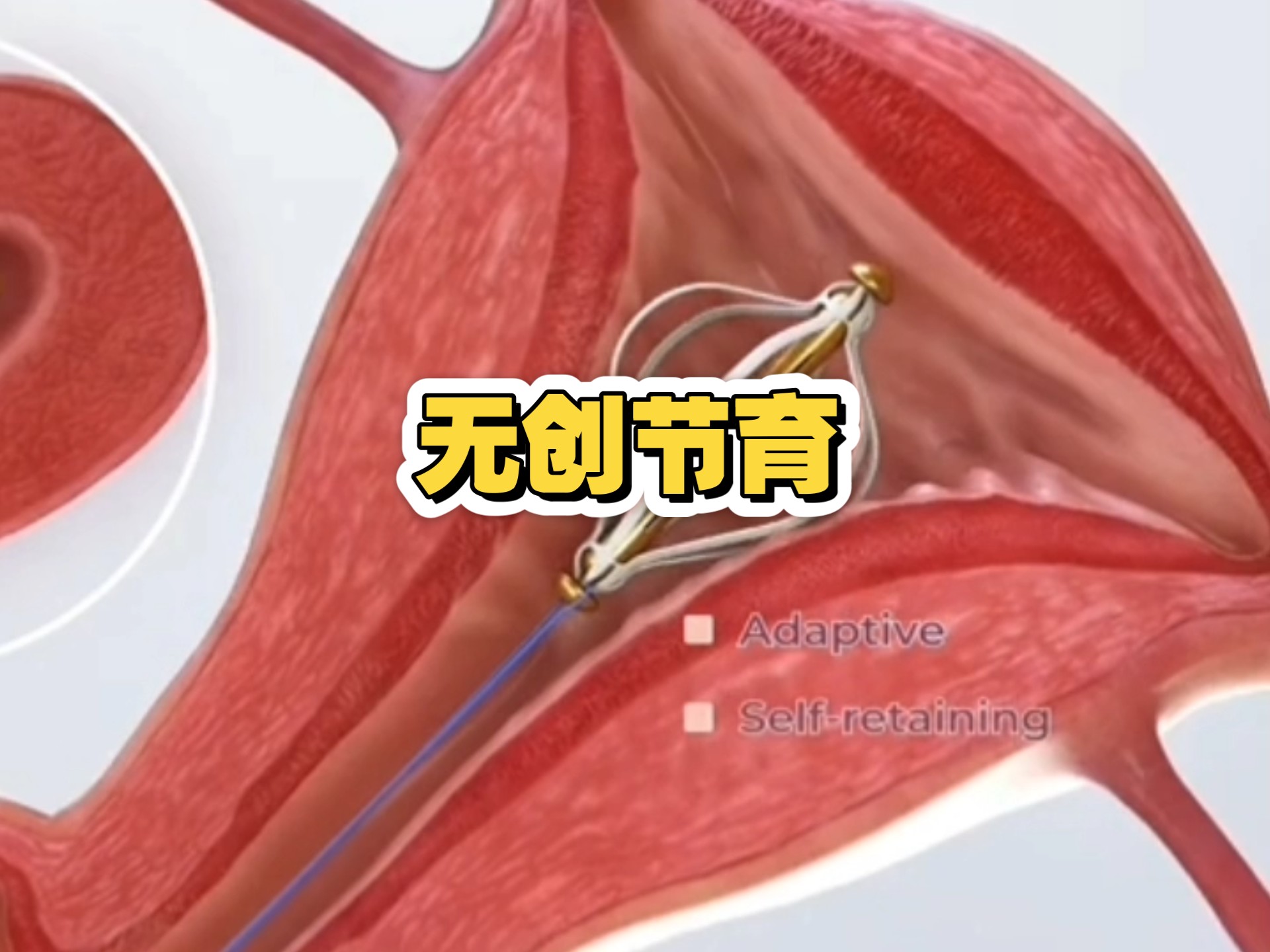 无创宫内节育器