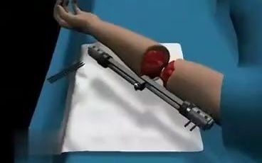 3D医学视频：手臂断了还可以再接起来，断臂重生！
