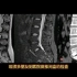 影像基础知识：“椎间盘变性”在CT和磁共振上如何诊断？医生讲解