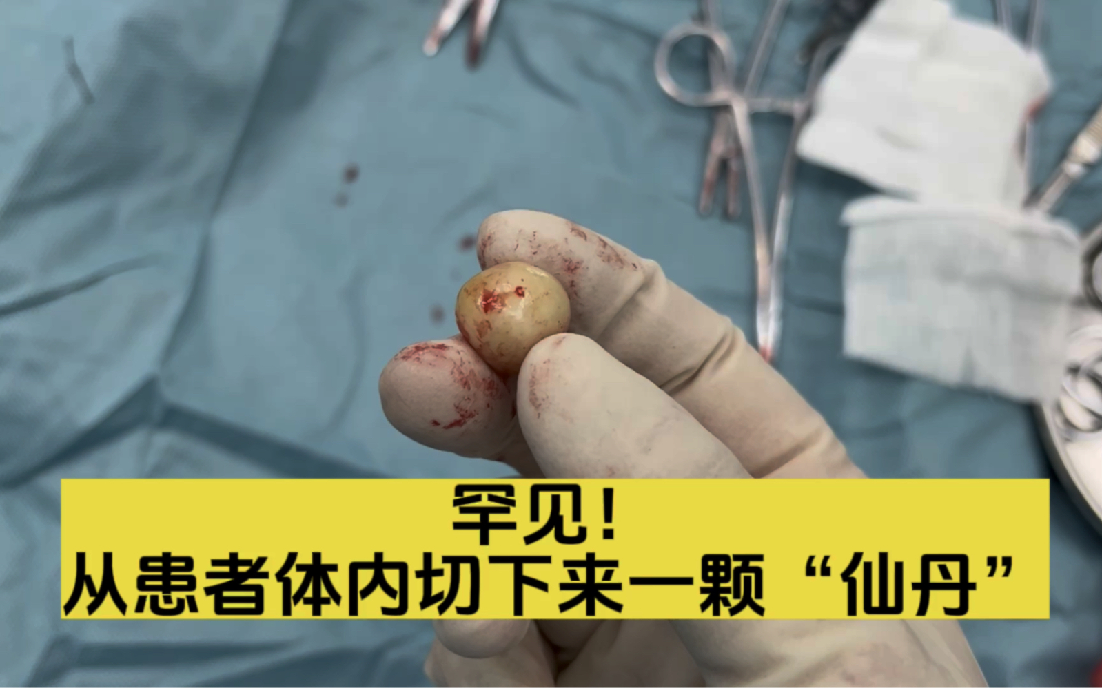 以为是普通肿物，没想到切下来一颗“仙丹”，医生也是第一次见！