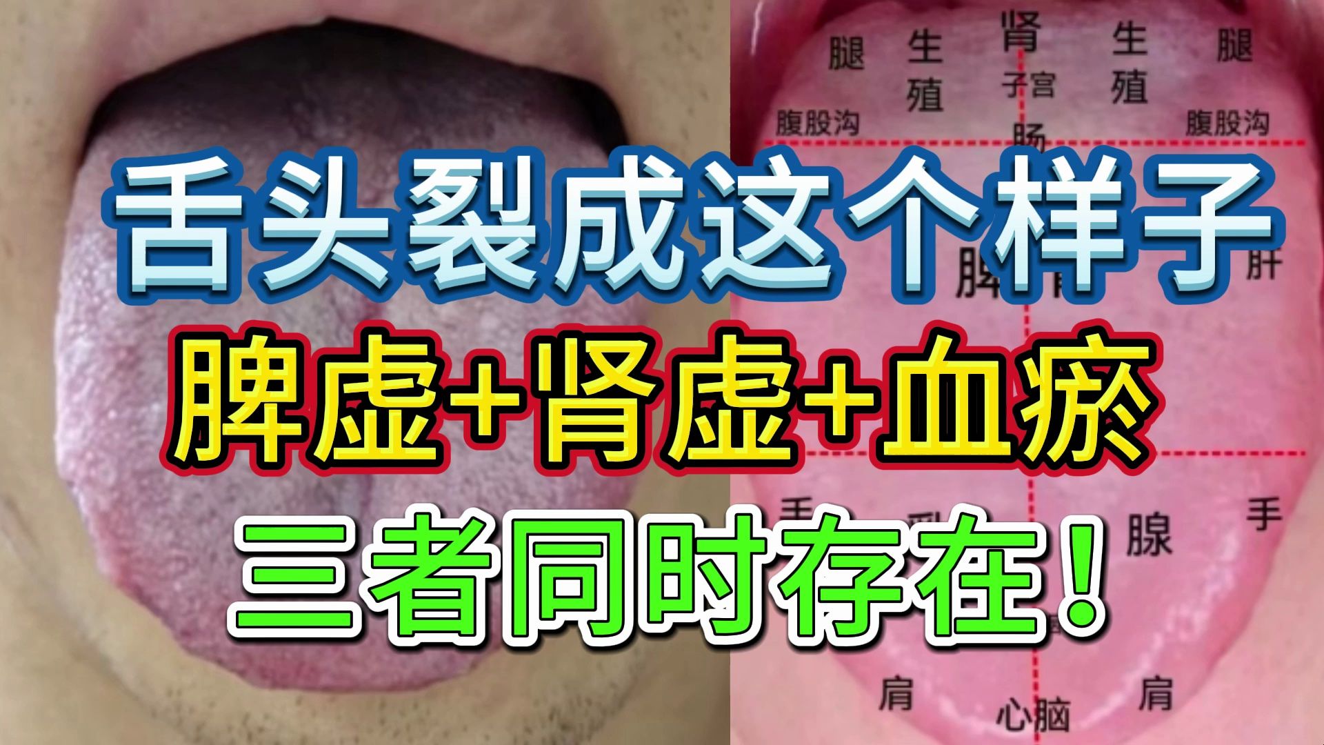 舌诊分析：舌头裂成这个样子，脾虚+肾虚+血瘀，三者同时存在！