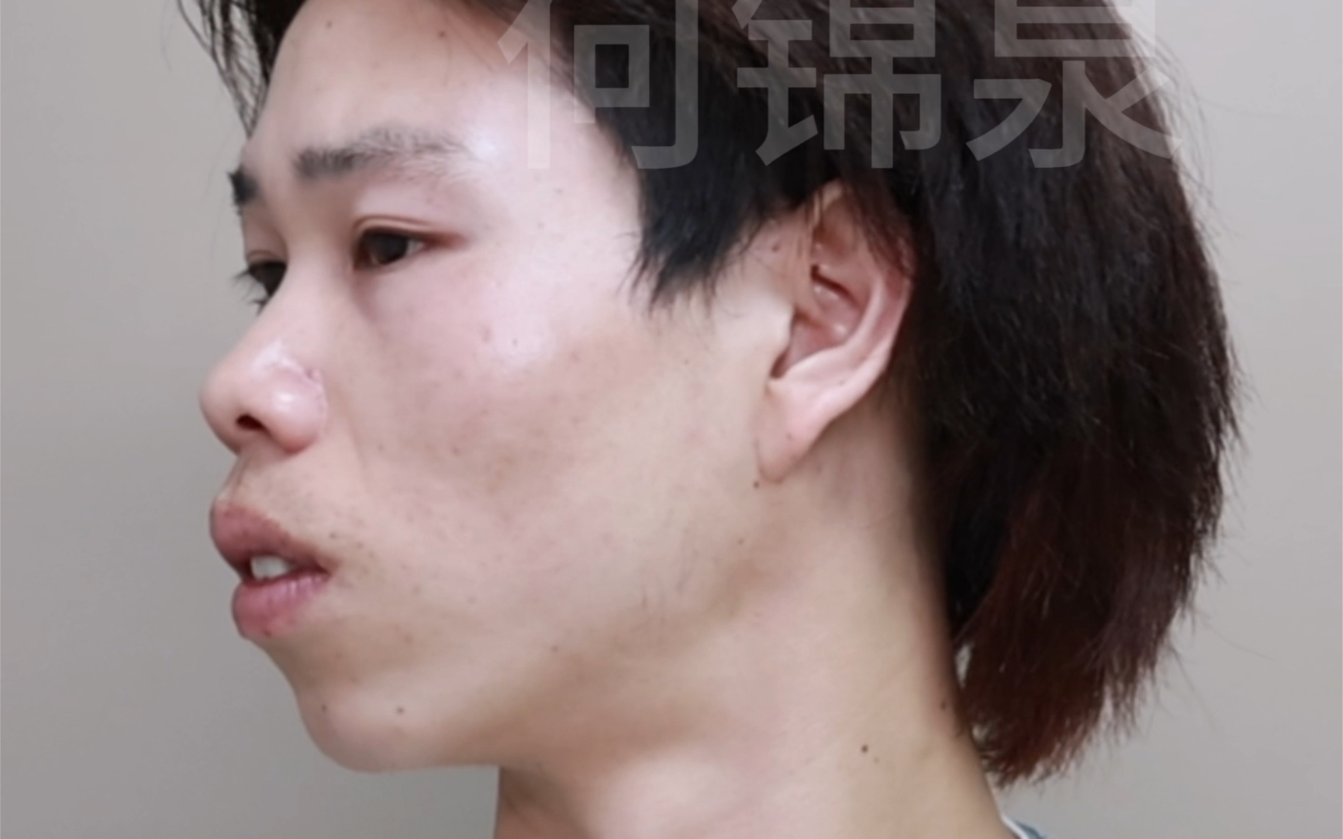 23岁男生凸嘴正颌矫正，正颌后14天的对比