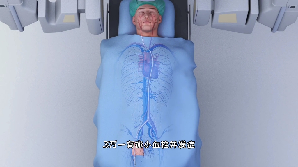 高精尖手术，介入微创弹簧圈填塞脑动脉瘤手术，3D演示。。