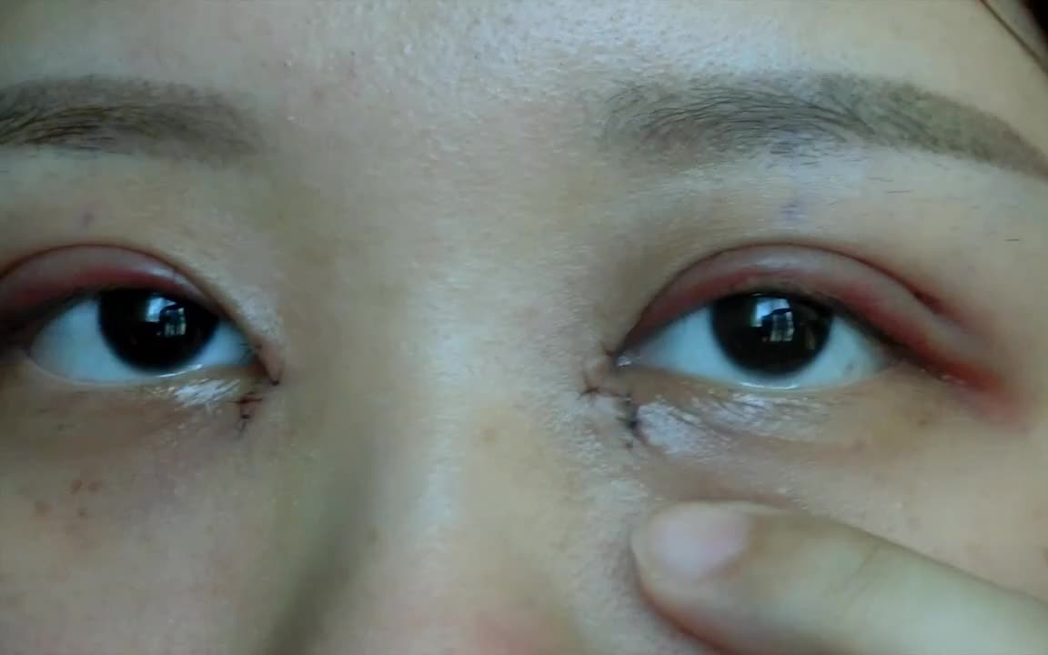 全切双眼皮 去皮 取脂肪 开内眼角记录术前术后 双眼皮宽度8mm 术前素颜效果 术后记录