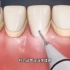 洗牙为什么会那么疼？3D效果揭秘其中原理，涨知识了！
