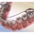 乳牙过早缺失会导致恒牙萌出异位，造成牙齿拥挤，间隙保持器可以帮助恒牙正位萌出哦「大连齿医生口腔修复中心」「大连口腔医院」