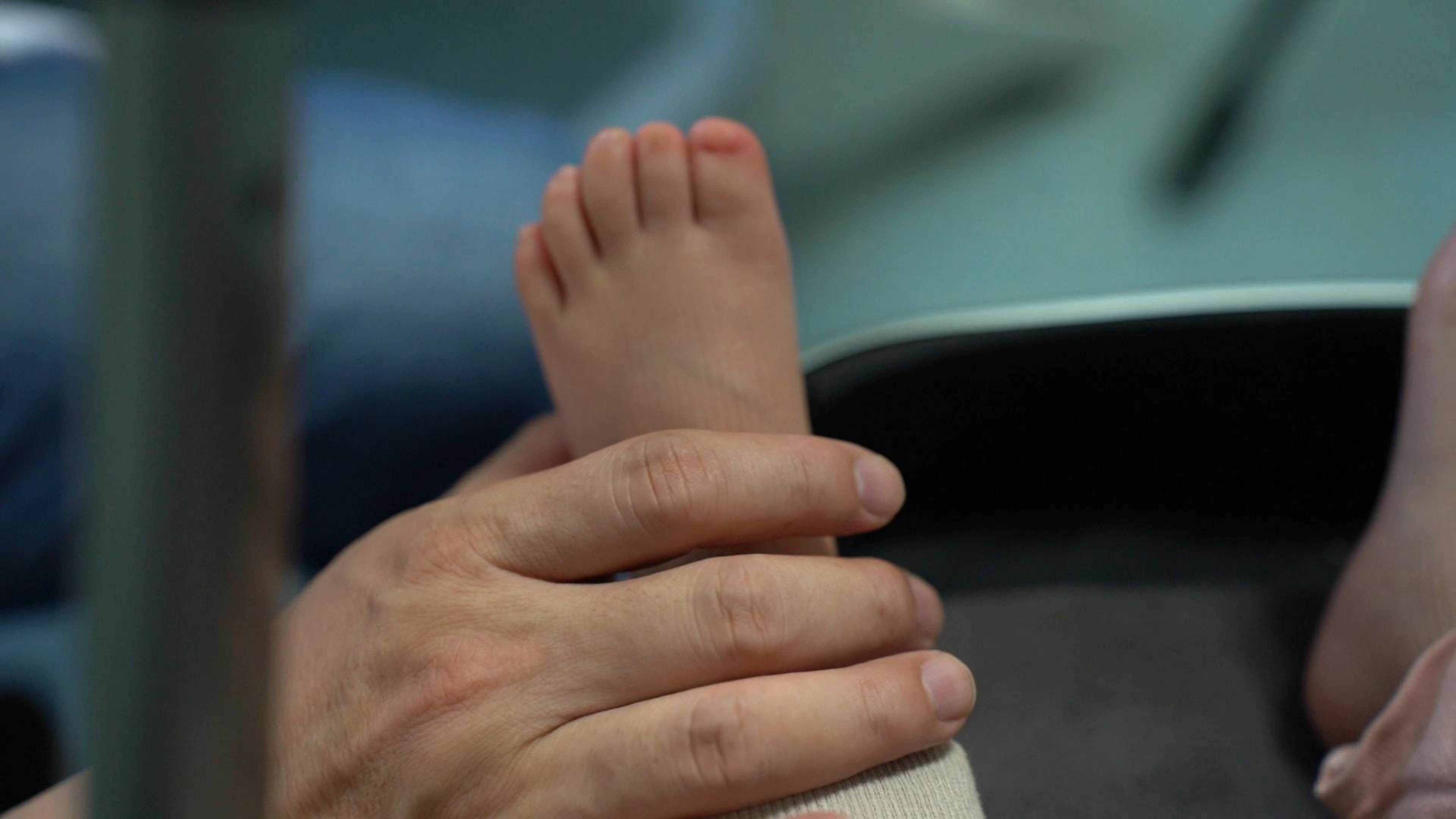 两岁女宝脚趾发育不良，医生：不用手术，涂指加油就行