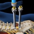 【3D医学动画】腰疼不要代入，腰椎融合术！