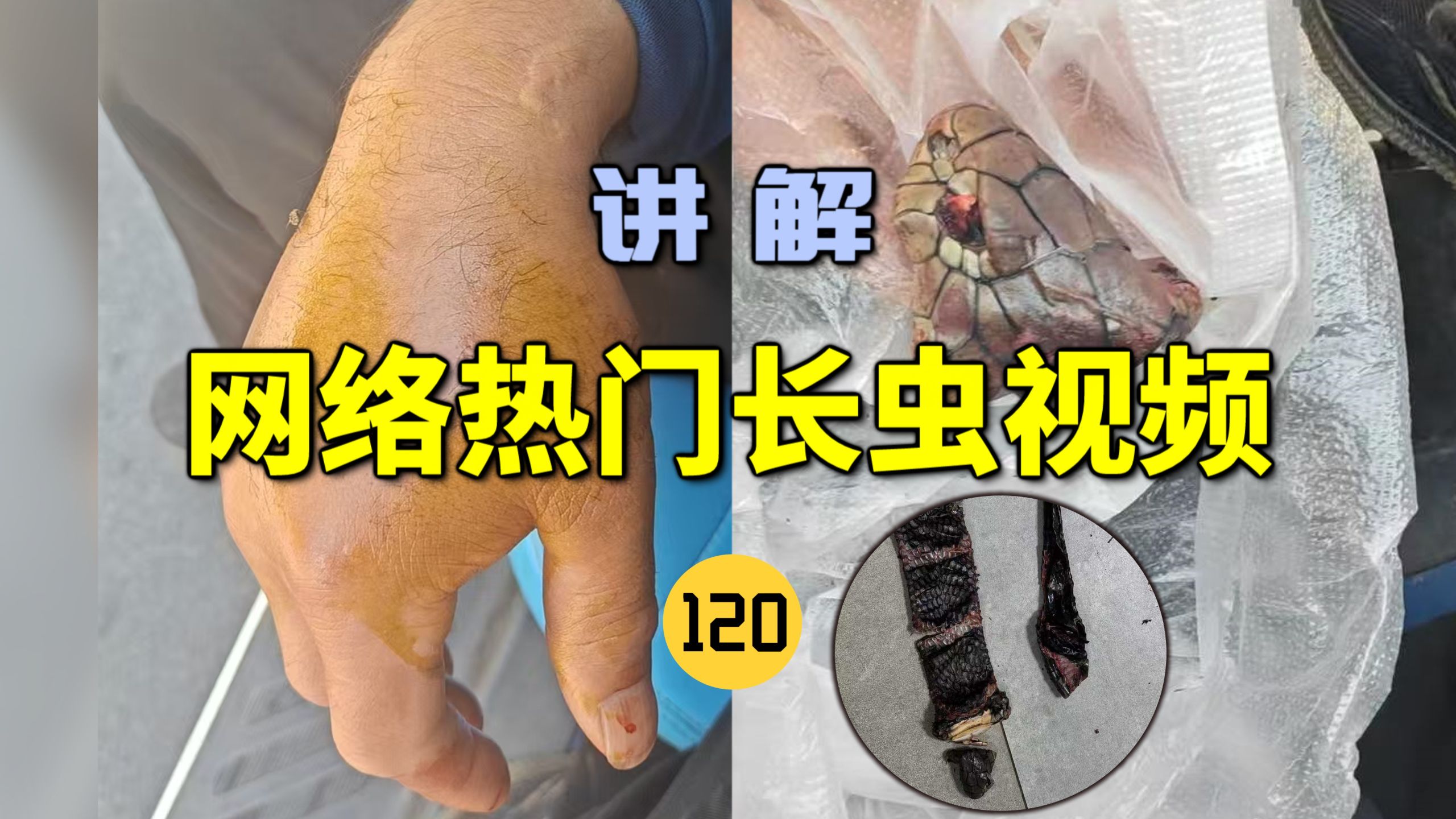 网络热门长虫视频(120)云南一村民被2米眼镜王蛇咬伤！打了13支血清才保住性命？