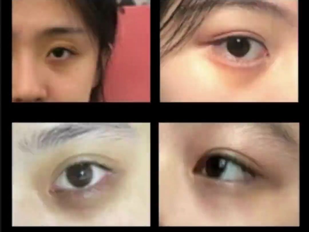 不同类型的黑眼圈，如何挑选好用的眼霜？？