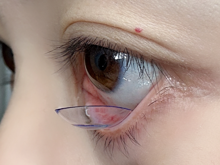 新手隐形眼镜摘戴方法，简单巨详细