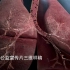 粉尘占领肺部全过程，3D动画带你了解尘肺病