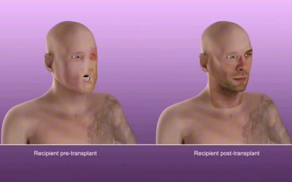 胆小勿入，半脸移植手术过程，3D演示。。