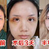 全切双眼皮+开眼角+肿眼泡矫正手术经验分享 | 单眼皮 内双 肿眼泡 | 手术过程疼不疼 | 面诊医院选择 | 武汉三甲医院