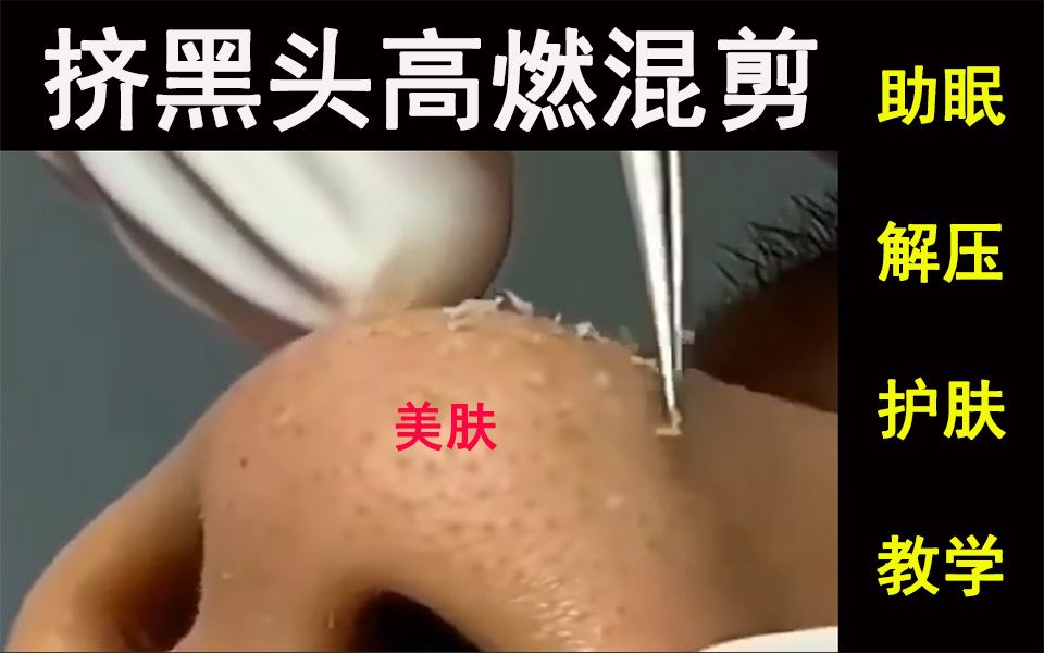 《挤黑头》各种肤质对比:美肤/解压/工具 切忌硬挤!