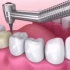 <深圳全瓷牙>牙冠修复和牙贴面修复的区别！