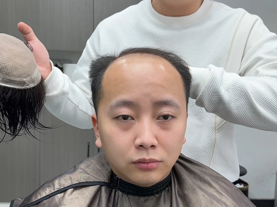 才30岁脱成这样，脱发真的是现代年轻人的噩梦。