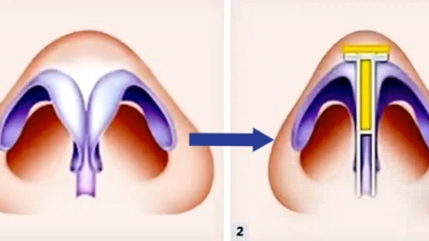 【Trumona】ug！在ASMR中延长鼻小柱