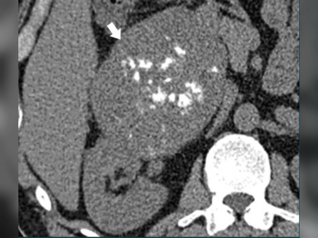 肾脏这种弥漫的磊片骨化强烈提示骨外骨肉瘤，影像学比较特异。