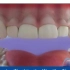 牙龈切除手术