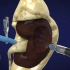 机器人肾肿瘤切除手术，3D演示。。