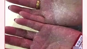 粉刺脓包怎么治疗最好 1c12ec6c7a3b93c8a0197974e0ae227aec48c5d7.jpg@280w_158h_1c_100q.jpg