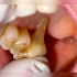 牙龈萎缩也叫牙肉萎缩，是一种缓慢的牙周病，并且还会出现刷牙出血、口臭、咀嚼时疼痛、牙缝大、牙齿松动等牙周病症状，不控制恶