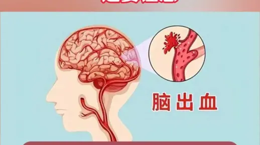 脑出血来信号一定要注意