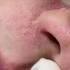 【沉浸式护理】ASMR鼻部痤疮--治疗痤疮的方法
