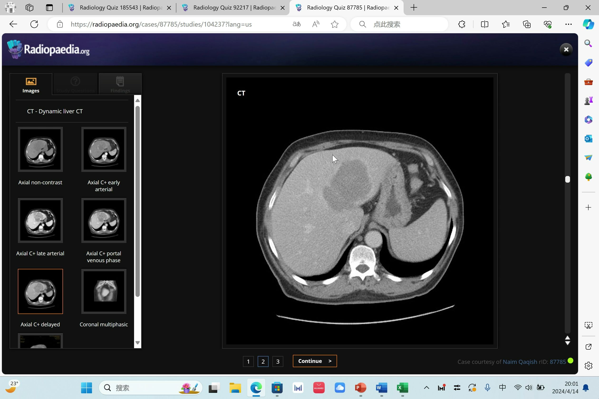 原发性肝癌/肝血管瘤/肝囊肿增强CT表现