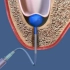 牙槽骨吸收要植骨种牙，你会选哪一种方式植骨？看着第二种好一点
