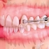 牙齿矫正过程
