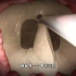 看不到切口的手术，经鼻孔垂体瘤切除手术，3D演示。。