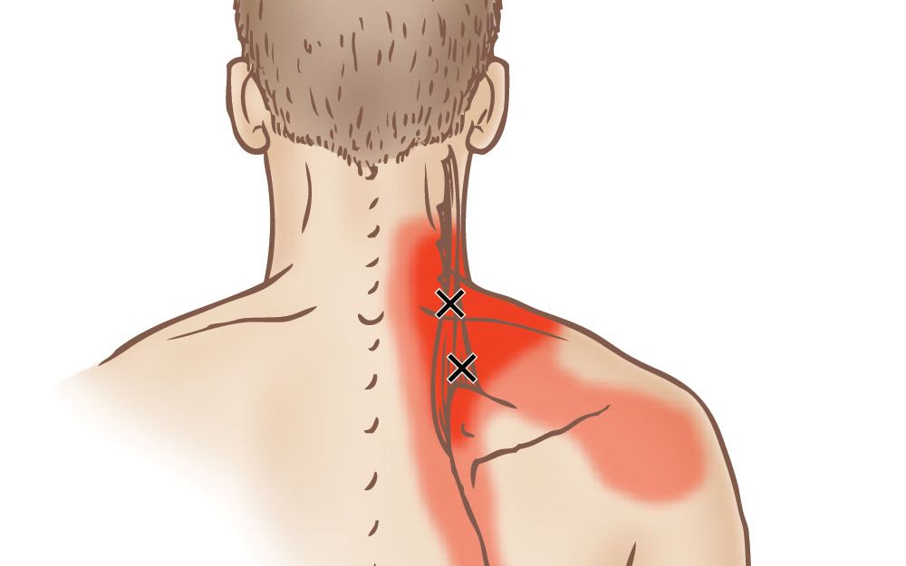 头颈前引的人，更容易使这块肌肉劳损，从而引发肩胛骨上角处疼痛。